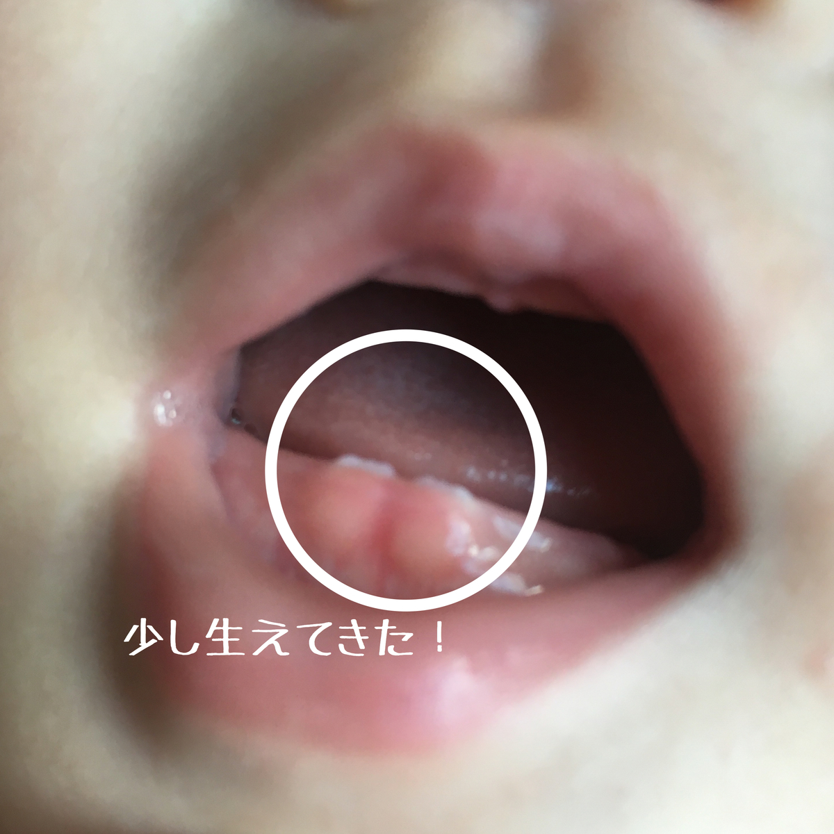 生後8か月歯が萌出 歯が生えてきた赤ちゃん