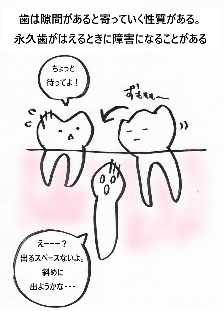早期に歯がなくなると残っている歯が傾く f:id:ha-tadanohito:20190504014102j:plain